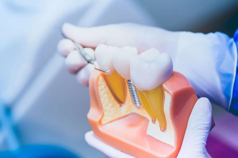 Εμφυτευματολόγοι Λάρισα ~ Οδοντιατρος Κολώνα Χάιδω-Βασιλική