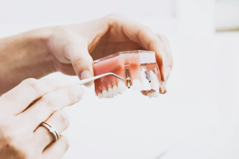 Εμφυτεύματα Δοντιών και Επιπλοκές - Οδοντίατροι Λάρισα - Κολώνα Χάιδω Βασιλική