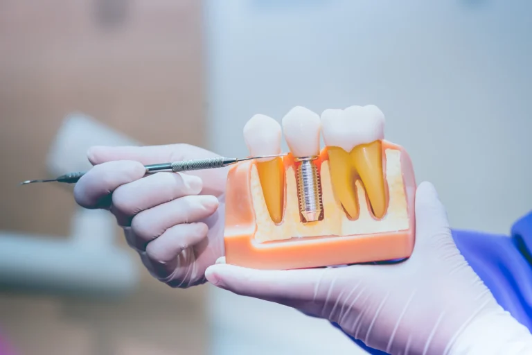 Εμφυτεύματα ή Γέφυρες Δοντιών: Σύγκριση - Οδοντίατροι Λάρισα - Κολώνα Χάιδω Βασιλική